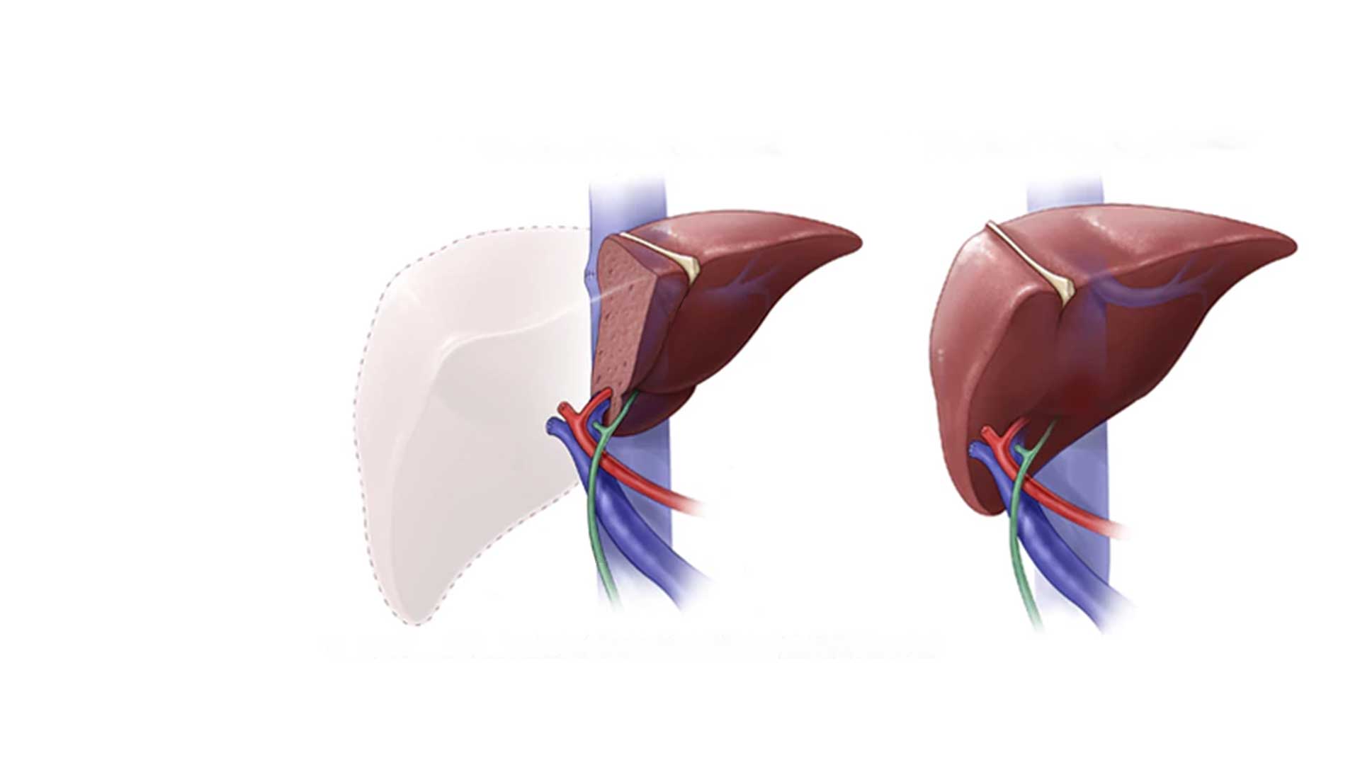 Hepatobiliary Surgery In India