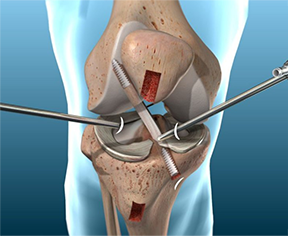 Acl Reconstruction