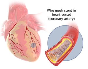 Angioplasty and Stent Replacement