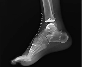Ankle Replacement Surgery