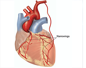 Coronary Artery Bypass Grafting Or CABG