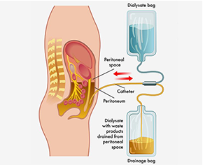 Dialysis