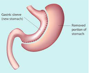 Gastric Sleeve Surgery 