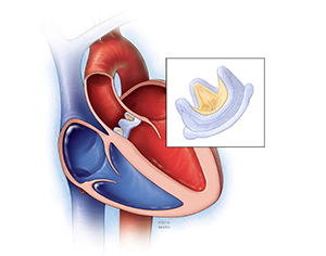 Heart Valve Surgery