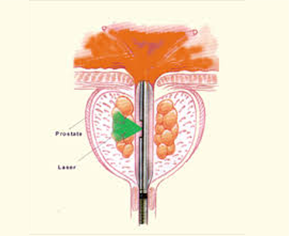 Transurethral resection of the prostate (TURP)