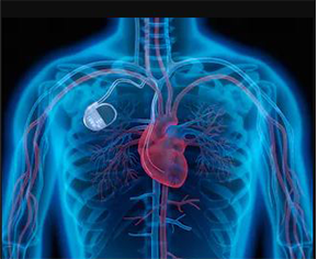 Pacemaker Implantation
