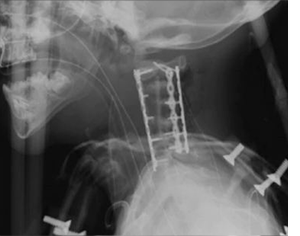 Pediatric Cervical Spine Surgery