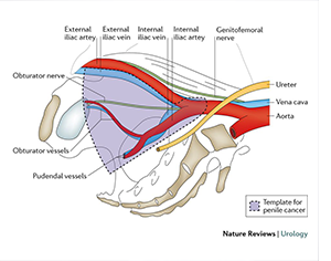 Pelvic Lymph Node Dissection