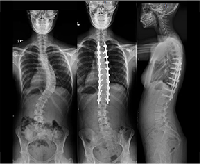 Scoliosis Surgery 