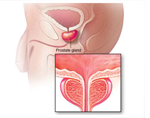 Transurethral incision of the prostate (TUIP)